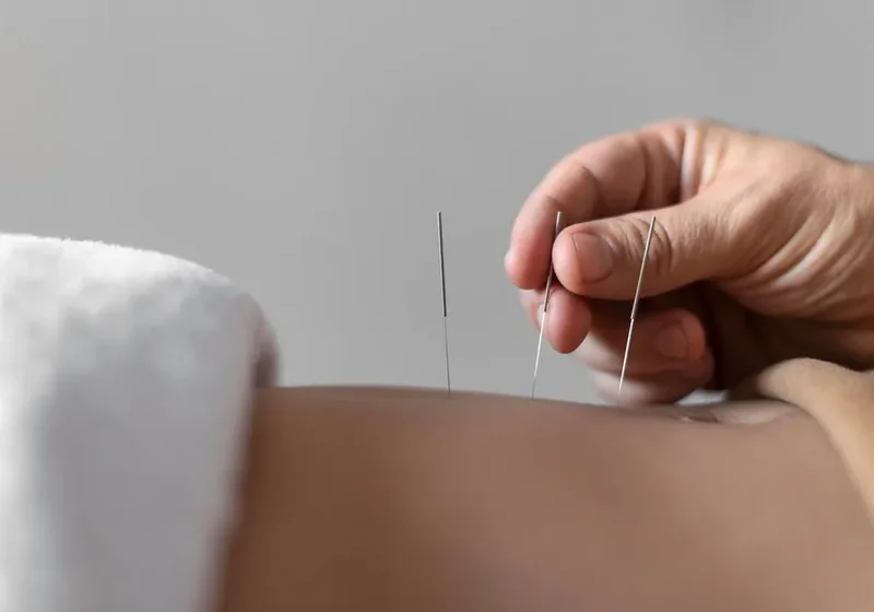 Acupuncture at Jewel Physical Therapy in Reseda