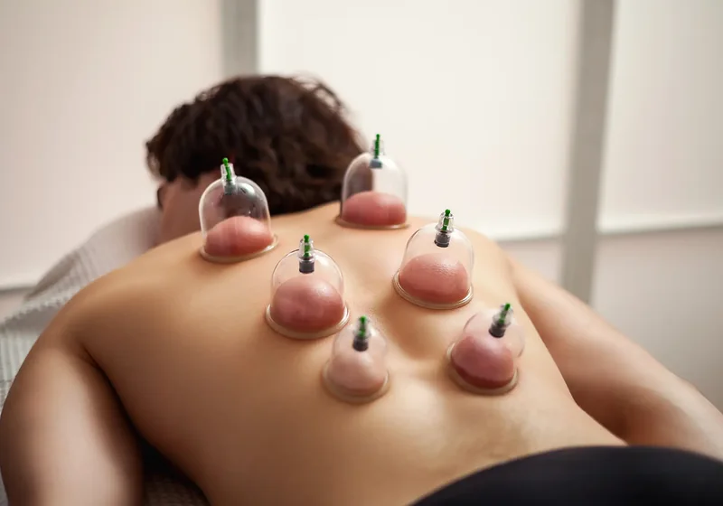 Cupping at Jewel Physical Therapy in Reseda